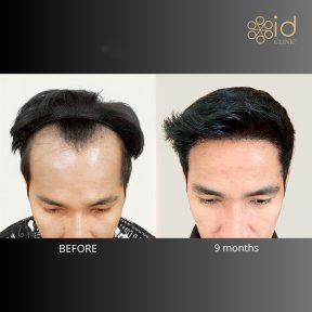 FUE-Haartransplantation Ergebnisse bei ID Clinic Bangkok, vollere Haarlinie nach 9 Monaten