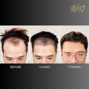 FUE-Haartransplantation Vorher-Nachher bei ID Clinic Bangkok – sichtbare Haarlinienverbesserung