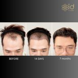 FUE-Haartransplantation Vorher-Nachher bei ID Clinic Bangkok – sichtbare Haarlinienverbesserung