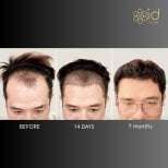 Vorher-nachher-Ergebnis Haartransplantation bei ID Clinic Bangkok – Haaransatz nach 7 Monaten