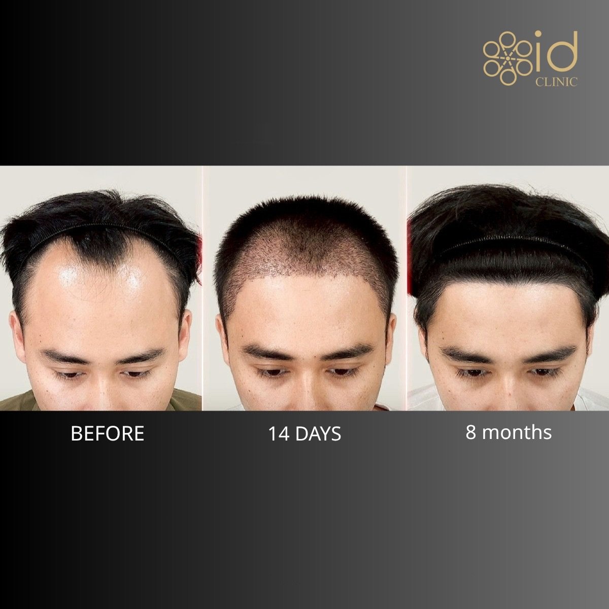 نتائج زراعة الشعر قبل وبعد في ID Clinic Bangkok، استعادة خط الشعر خلال 8 أشهر