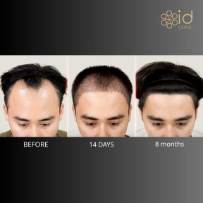 Vorher-nachher-Ergebnis Haartransplantation bei ID Clinic Bangkok, Haaransatz nach 8 Monaten