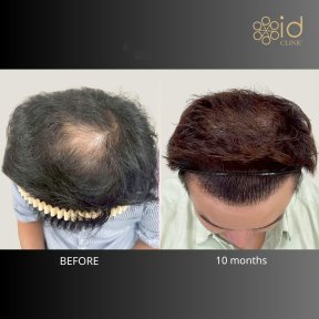 Ergebnis Haartransplantation bei ID Clinic Bangkok – volleres Haar nach 10 Monaten