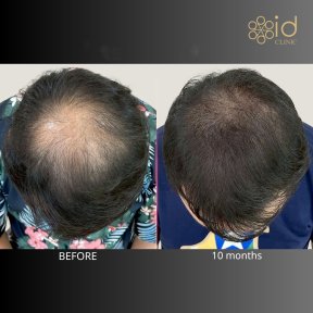 Vorher-nachher-Ergebnis Haartransplantation bei ID Clinic Bangkok, sichtbare Haardichte