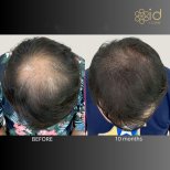 Vorher-nachher-Ergebnis Haartransplantation bei ID Clinic Bangkok, sichtbare Haardichte