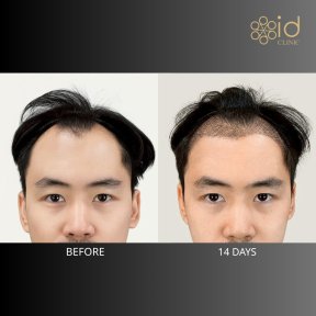 Vorher-nachher-Ergebnis Haartransplantation bei ID Clinic Bangkok, verbesserter Haaransatz in 14 Tagen