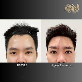 Vorher-nachher-Ergebnis Haartransplantation bei ID Clinic Bangkok, verbesserter Haaransatz nach 1 Jahr 9 Mon.
