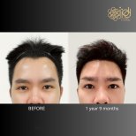 Vorher-nachher-Ergebnis Haartransplantation bei ID Clinic Bangkok, verbesserter Haaransatz nach 1 Jahr 9 Mon.