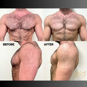 Before and after gynecomastia surgery results at ID Clinic Bangkok, improved chest contour