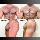Before and after gynecomastia surgery results at ID Clinic Bangkok, improved chest contour