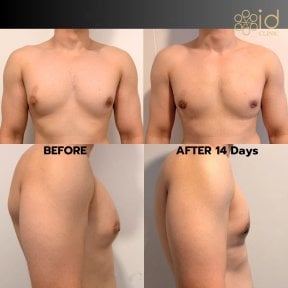 Gynecomastia surgery before and after results at ID Clinic Bangkok, flatter chest in 14 days