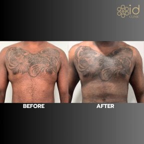 Before and after gynecomastia surgery results at ID Clinic Bangkok, flatter male chest