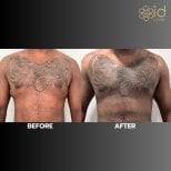 Before and after gynecomastia surgery results at ID Clinic Bangkok, flatter male chest