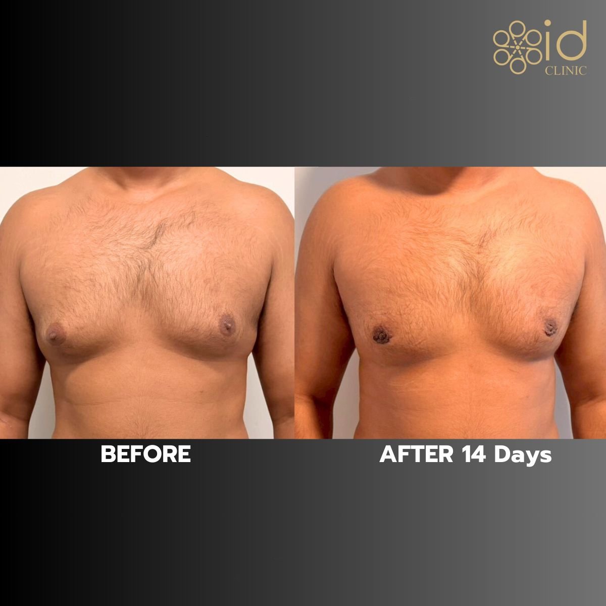 نتائج عملية التثدي قبل وبعد في ID Clinic Bangkok، تحسين مظهر الصدر
