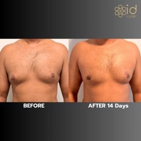 Gynecomastia surgery before and after results at ID Clinic Bangkok, chest contour improvement