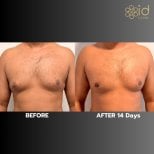 Gynecomastia surgery before and after results at ID Clinic Bangkok, chest contour improvement
