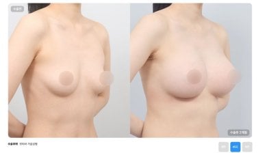 Before and after breast lift results at AB Plastic Surgery Clinic, improved breast contour