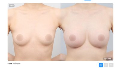 Before and after breast lift results at AB Plastic Surgery Clinic – improved breast contour