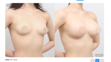 Before and after breast lift results at AB Plastic Surgery Clinic, improved breast contour