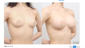Before and after breast lift results at AB Plastic Surgery Clinic, improved breast contour