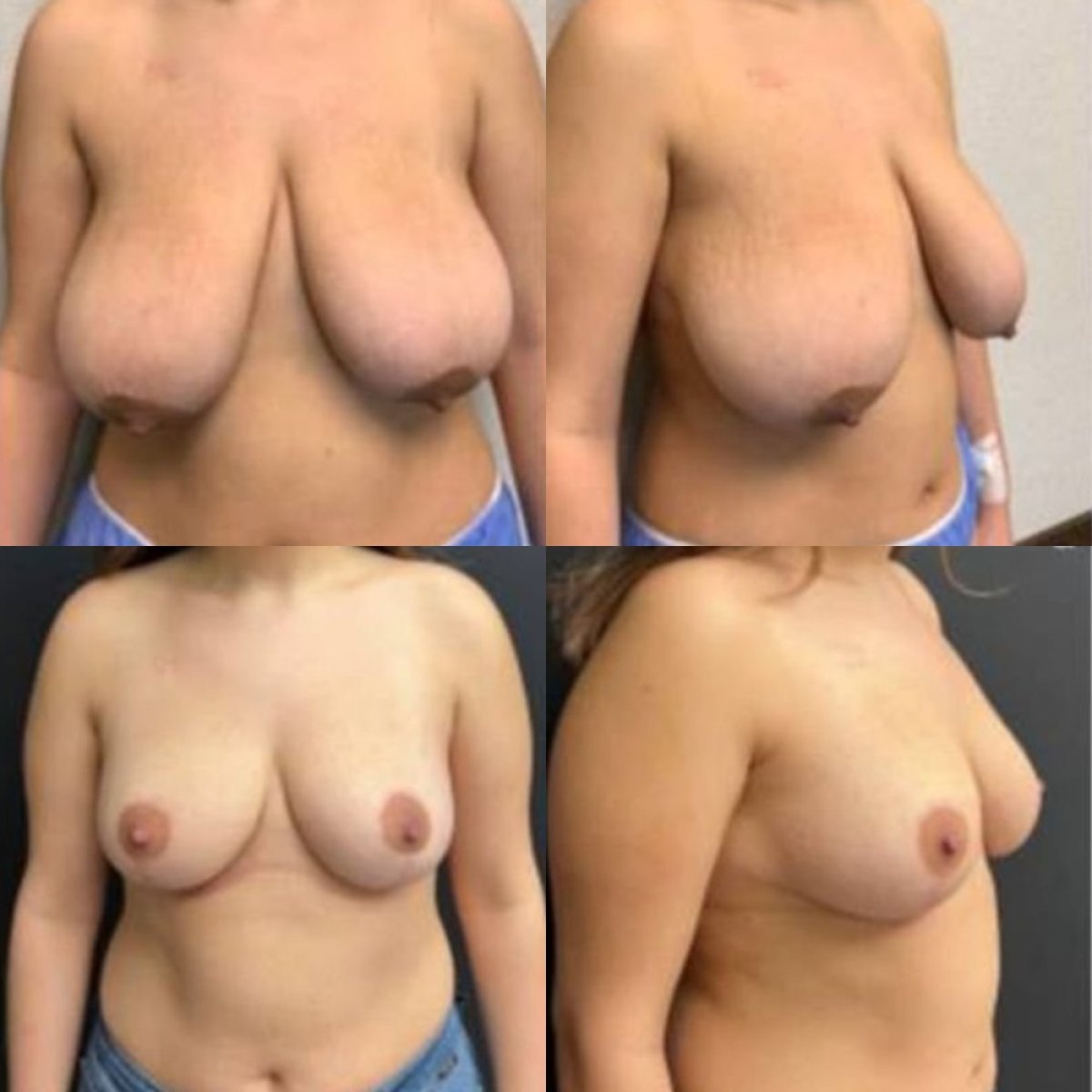 نتائج تصغير الثدي قبل وبعد في مستشفى ميموريال شيشلي، تحسين شكل الثدي