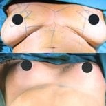 Before and after breast implants with lift at Memorial Şişli Hospital, enhanced breast contour result