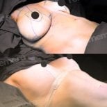 Before and after breast implants with breast lift results at Memorial Şişli Hospital