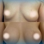 Before and after breast implants with lift results at Memorial Şişli Hospital, enhanced contour
