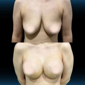 Before and after breast implants with lift results at Memorial Şişli Hospital, enhanced contour