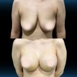 Before and after breast implants with lift results at Memorial Şişli Hospital, enhanced contour