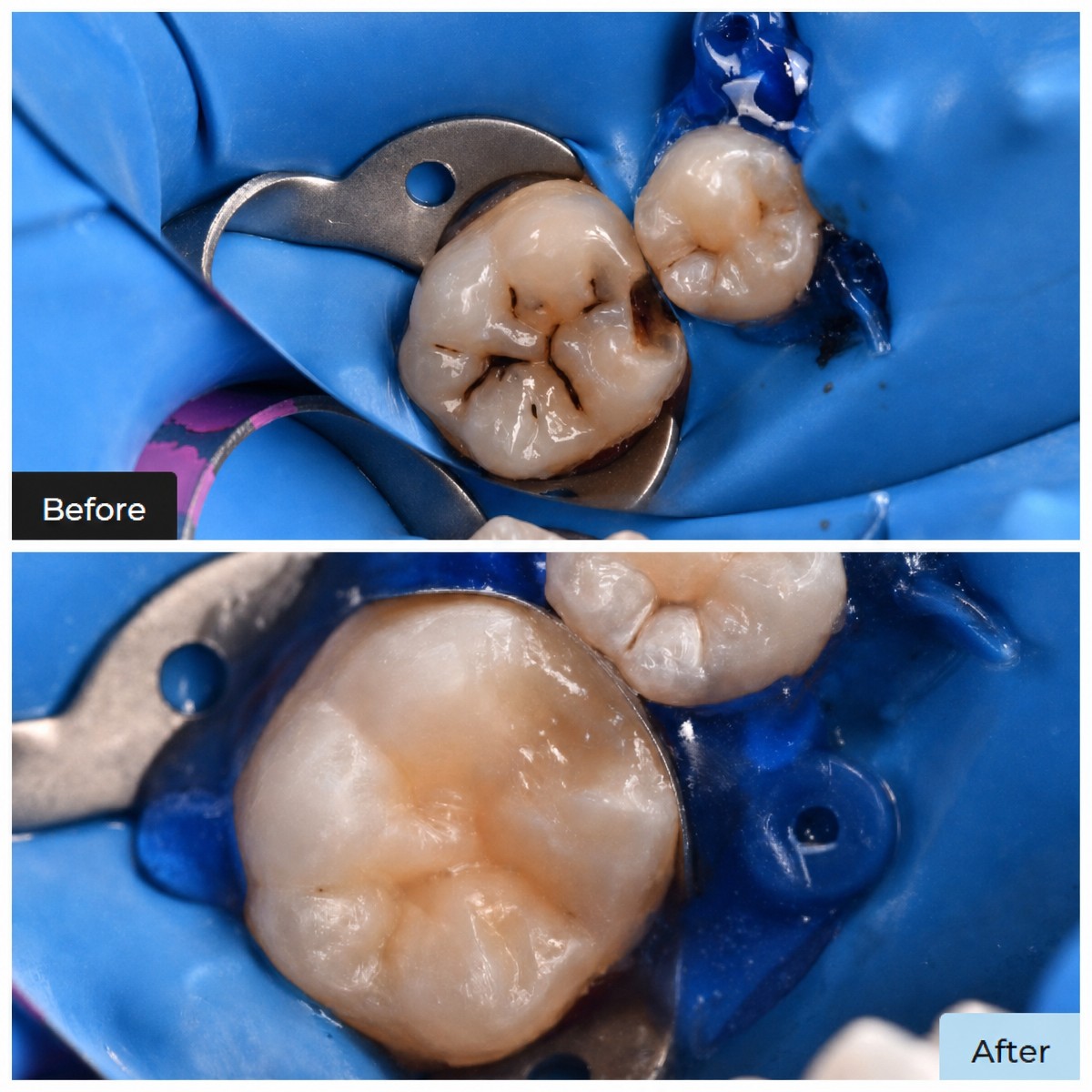 نتائج قبل وبعد حشو الكمبوزيت في عيادة Dental Clinic Dynasty Stomatology في كراكوف