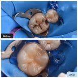 Resultados antes y después de empaste de composite en Dental Clinic Dynasty Stomatology en Cracovia