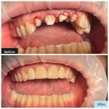 Before and after tooth restoration bonding results at Dental Clinic Dynasty Stomatology Krakow