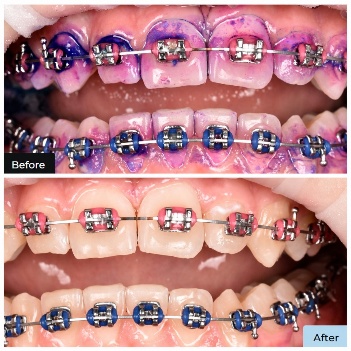 Antes y después de limpieza dental (scaling) con brackets en Dental Clinic Dynasty Stomatology Cracovia