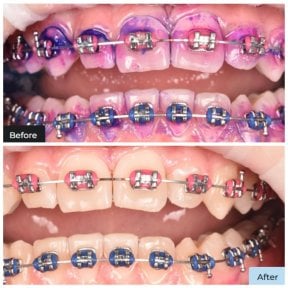 До и после чистки зубов (скейлинг) с брекетами в Dental Clinic Dynasty Stomatology Краков