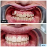 Vorher-nachher-Ergebnis Clear Aligner bei Dental Clinic Dynasty Stomatology in Krakau