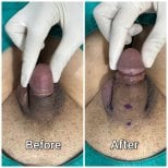 Before and after penis filler results at Eternity Clinic Pleonchit – visible girth enhancement