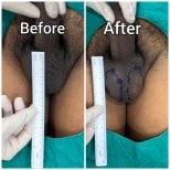 Before and after penis filler results at Eternity Clinic Pleonchit, visible enhancement achieved