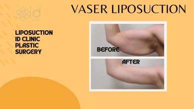 before-after photo liposuction-5-body-areas