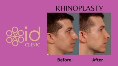 before-after photo rhinoplasty-nose-job