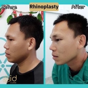 before-after photo rhinoplasty-nose-job