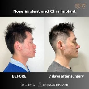 before-after photo rhinoplasty-nose-job