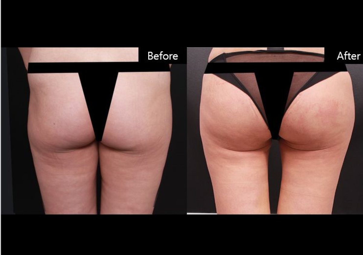 نتائج شفط الدهون فايزر قبل وبعد في VG Plastic Surgery، تحسين شكل الأرداف