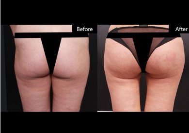 Результаты до и после Vaser-липосакции в VG Plastic Surgery, улучшенный контур ягодиц