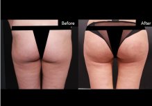 Результаты до и после Vaser-липосакции в VG Plastic Surgery, улучшенный контур ягодиц