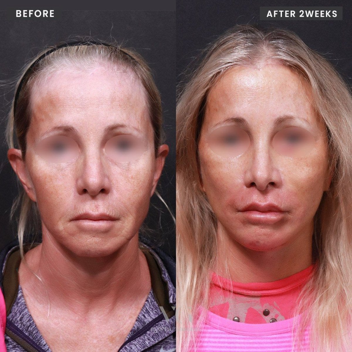 Resultados antes y después de Deep Plane Facelift en VG Plastic Surgery, rejuvenecimiento facial visible