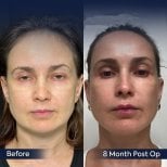 Vorher-nachher-Ergebnis Deep Plane Facelift bei Dr. Safa Manav, 8 Monate post-op