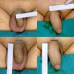 Before and after penis enlargement results at ID Clinic Bangkok showing increased length and girth
