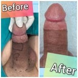 Результаты увеличения пениса до и после в Eternity Clinic Pleonchit, видимое увеличение