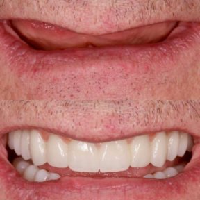 Before and after dental implants with sedation at BMC Dental Klinik, restored smile result